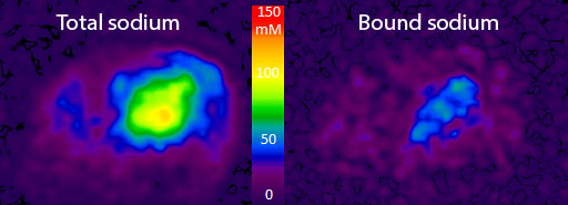 Bound Sodium Brain
